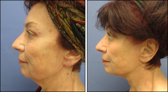 no scars at all behind the ears!